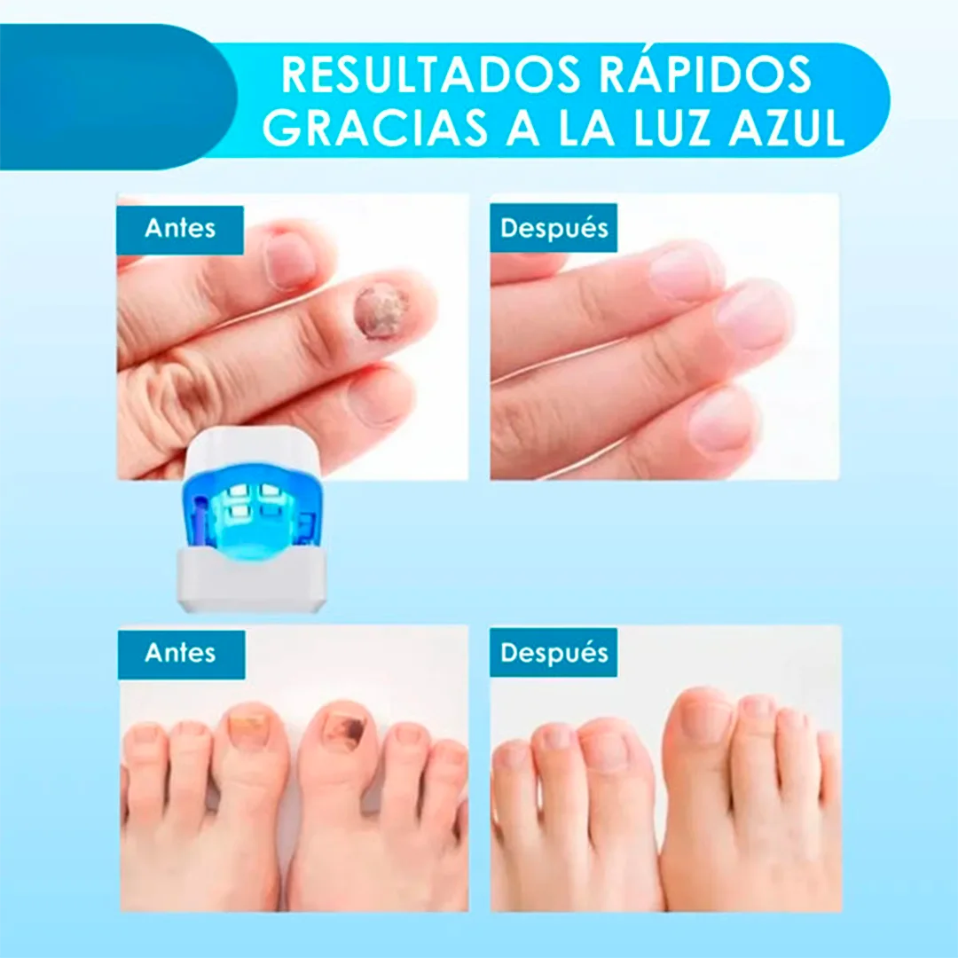¡Deshazte de los hongos y uñas débiles en solo 6 ciclos! Tratamiento láser rápido y seguro con CuraLáser.