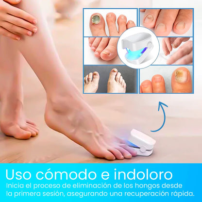 ¡Deshazte de los hongos y uñas débiles en solo 6 ciclos! Tratamiento láser rápido y seguro con CuraLáser.
