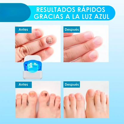¡Deshazte de los hongos y uñas débiles en solo 6 ciclos! Tratamiento láser rápido y seguro con CuraLáser.