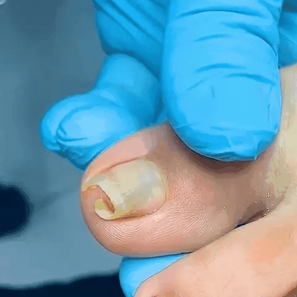 FUNGUSFREE - ANTI HONGO TOENAILPLUS - Compra 1 y llévate 2!